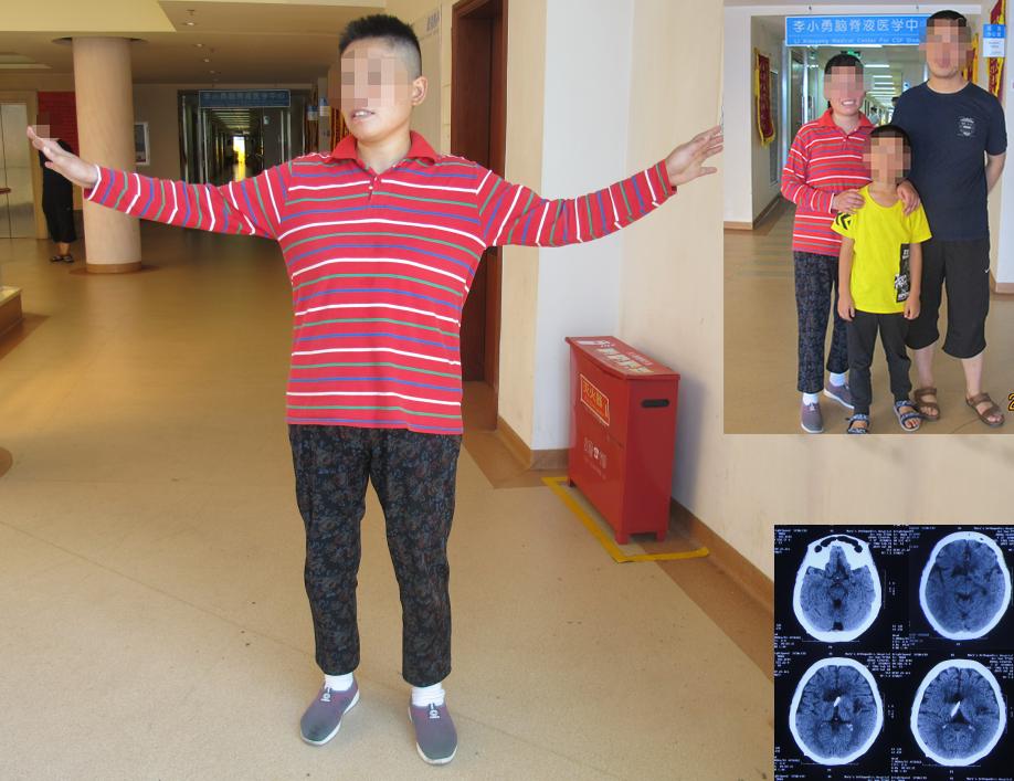 结核性脑积水,脑膜炎脑积水要治疗多久