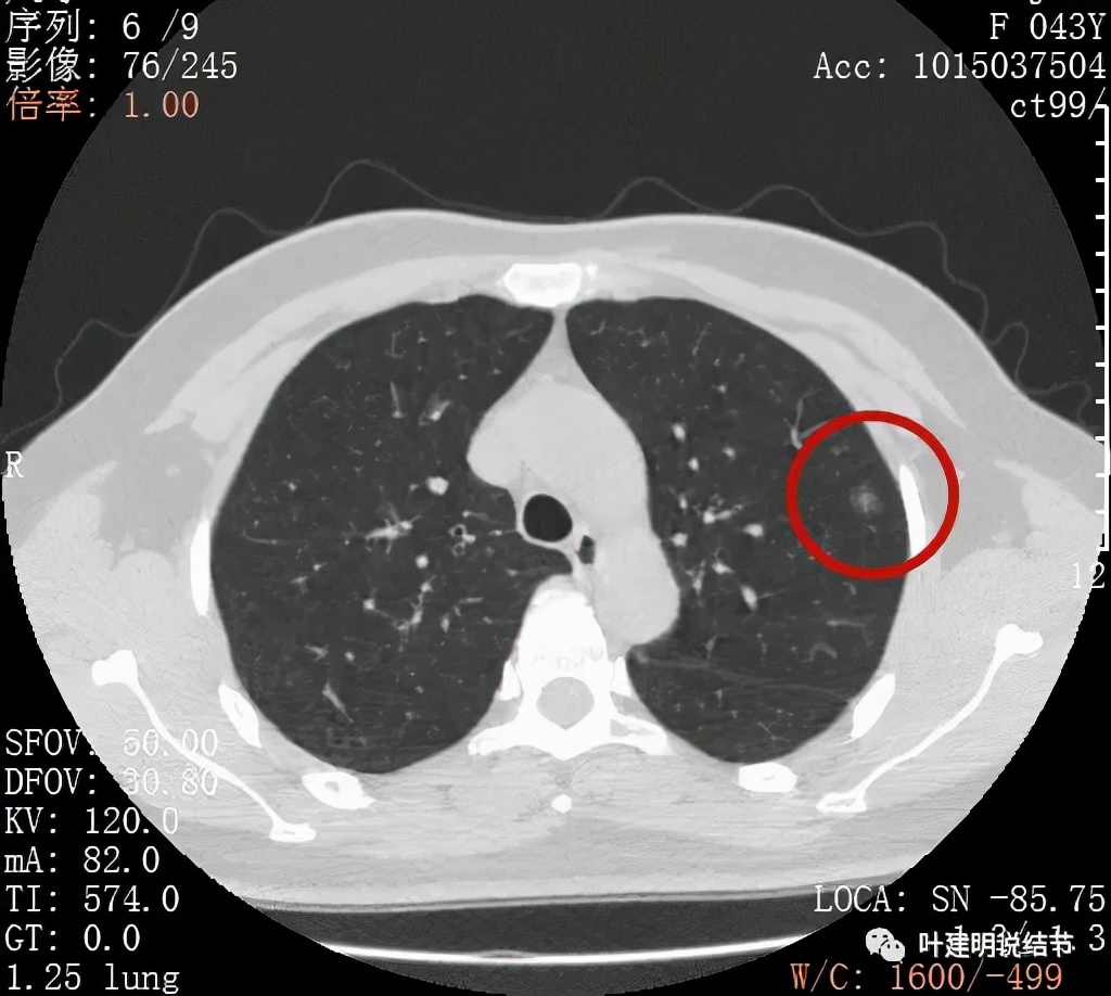 怎样从病理报告看是不是原位癌,原位腺癌切除子宫要开刀吗