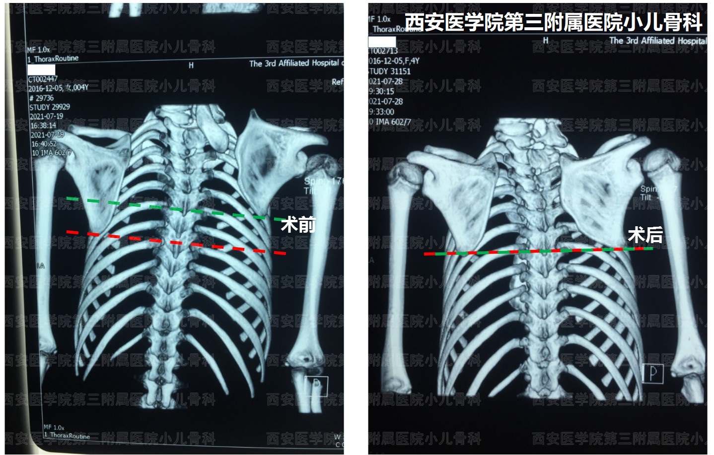 先天性高肩胛手术,先天性肩胛症通过手术需要多少钱