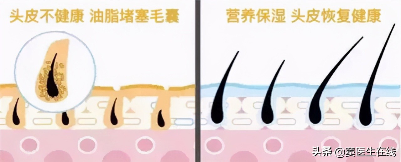 体毛要不要刮掉要一直处理吗,体毛刮掉对身体有什么影响