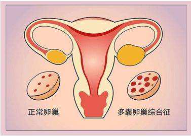 肥胖症：男女生育的绊脚石