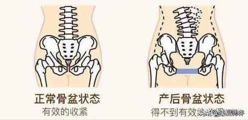 产后腹直肌分离的解决方法,产后腹直肌分离怎么处理
