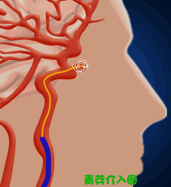 颅内动脉瘤介入栓塞支架全过程,颅内夹层动脉瘤介入演示