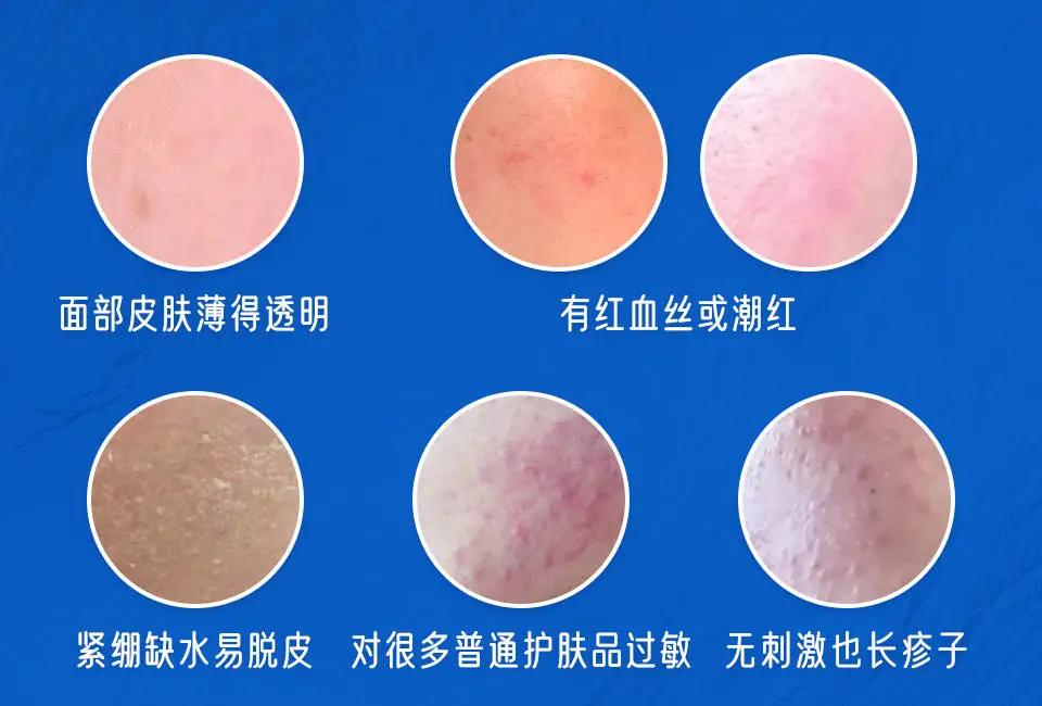 90%的肌肤问题都是皮肤缺水,100个皮肤问题