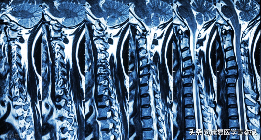 颈椎病中医能彻底治好吗,颈椎病中医能治吗