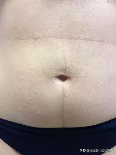 有鸡皮肤怎么露腿好看,如何改善腿部鸡皮皮肤肤质