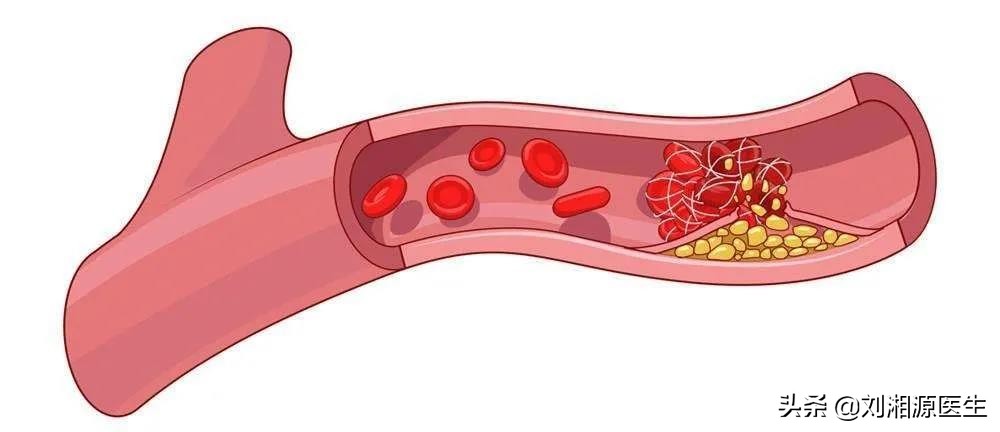 「免疫相关不良妊娠答疑解惑64」——凝血检查及易栓症