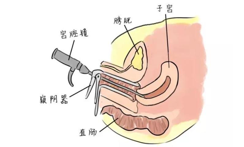 为什么一定要做腔内超声检查？