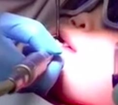 多图直击！牙医如何用抛光把孩子的牙洗干净？#葉子口腔科普#