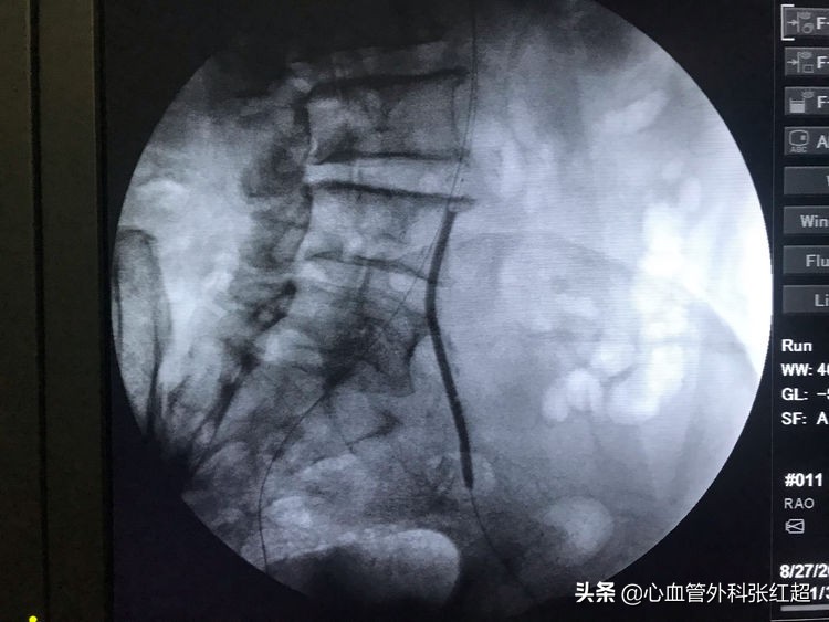 外周血管外科治疗范围,外周血管介入治疗疗程