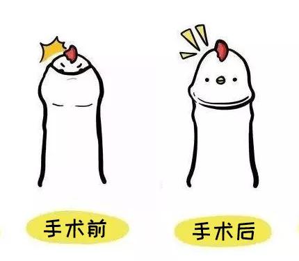 暑假扎堆割包皮,扎堆割包皮