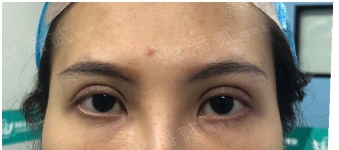全切双眼皮提肌失败还能修复吗,什么是失败的双眼皮