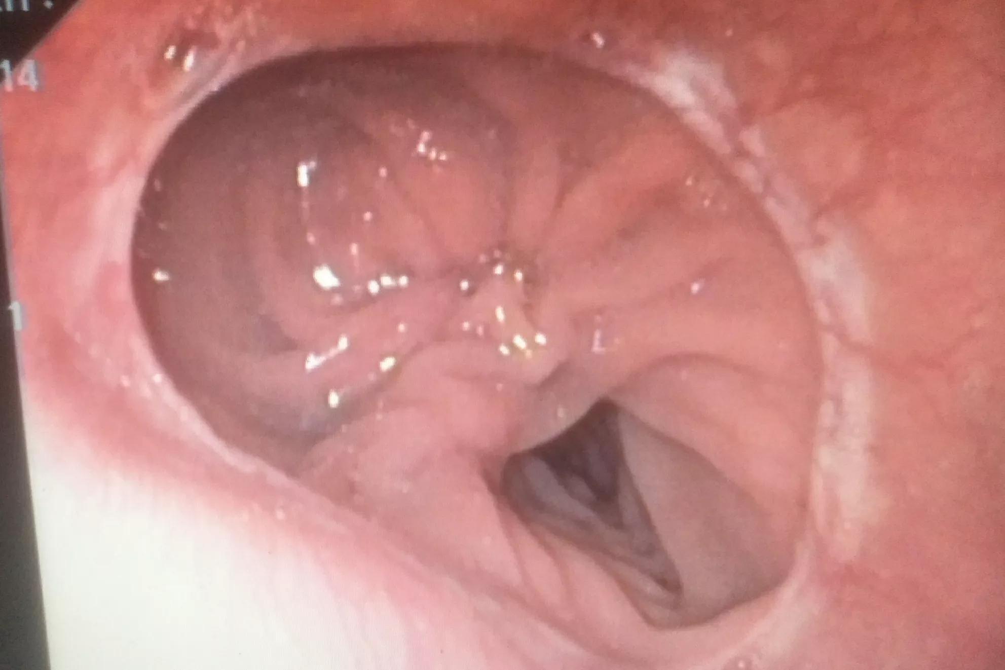 29岁的抗癌之路,26岁胃癌晚期死亡