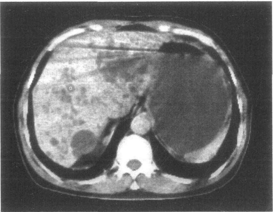 肝脏长东西就是癌症吗,肝脏长东西怕不怕
