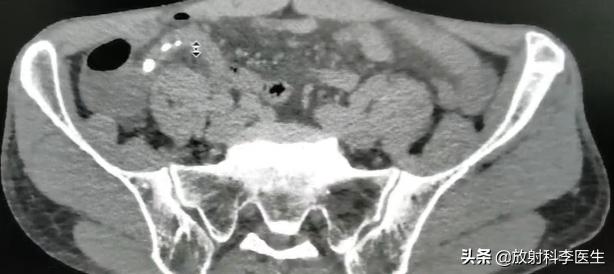 患者典型阑尾炎表现,为什么CT检查后李医生诊断为憩室炎?
