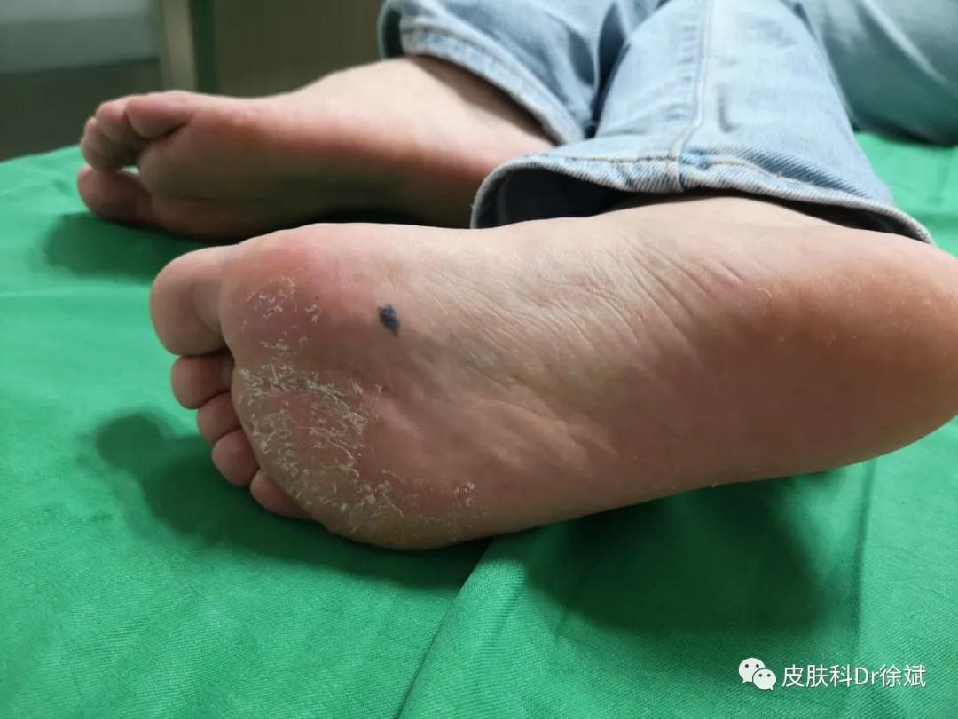 脚底所有黑痣都得切除吗,16岁脚底板长了黑痣一定要切除吗