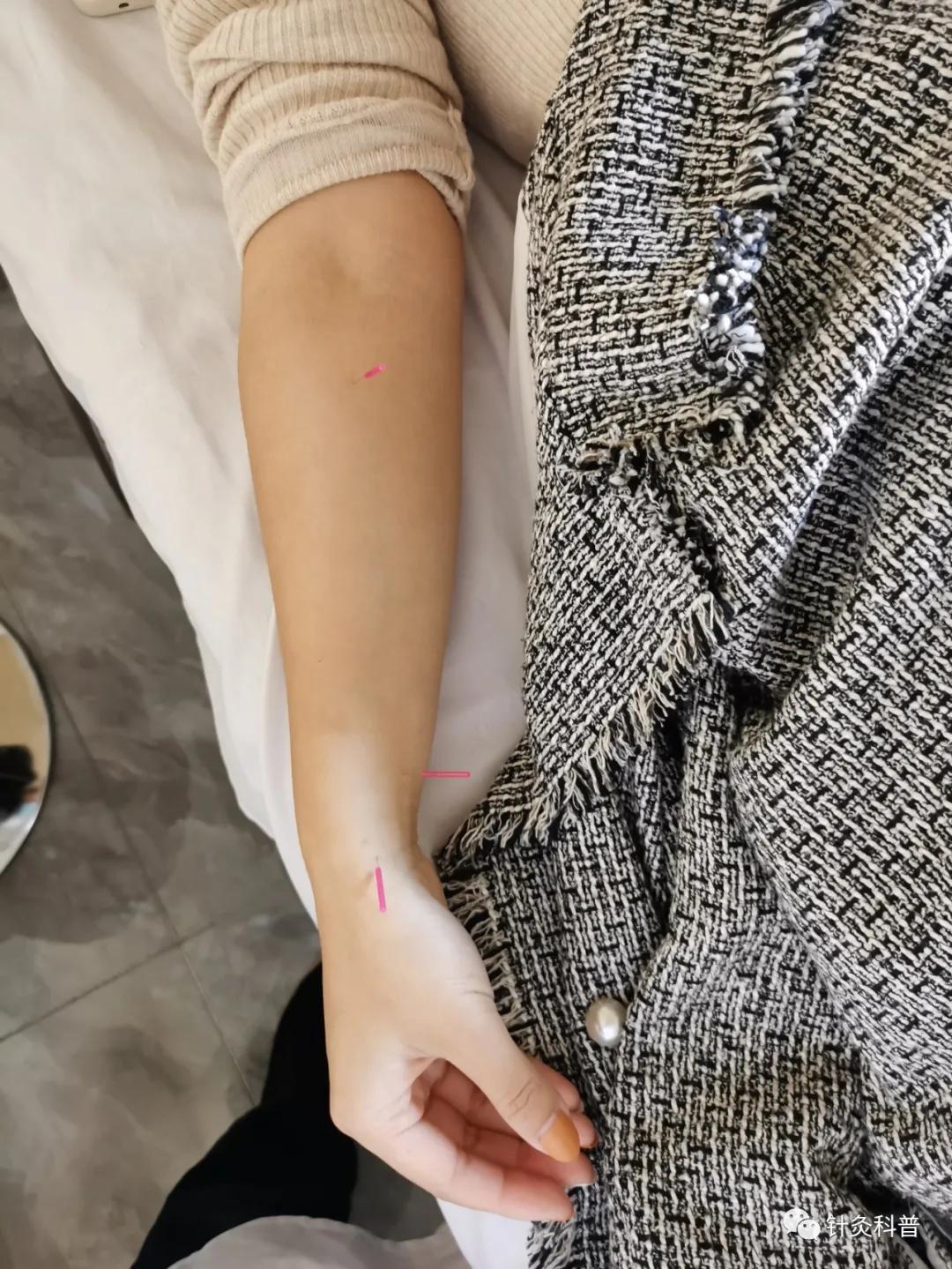 脉诊针灸视频教程,脉诊针灸穴位