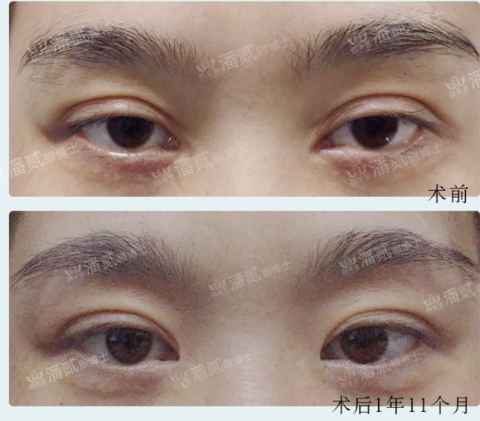 欧式大双眼皮和平行双眼皮,醒醒吧明智的放弃胜过盲目的执着