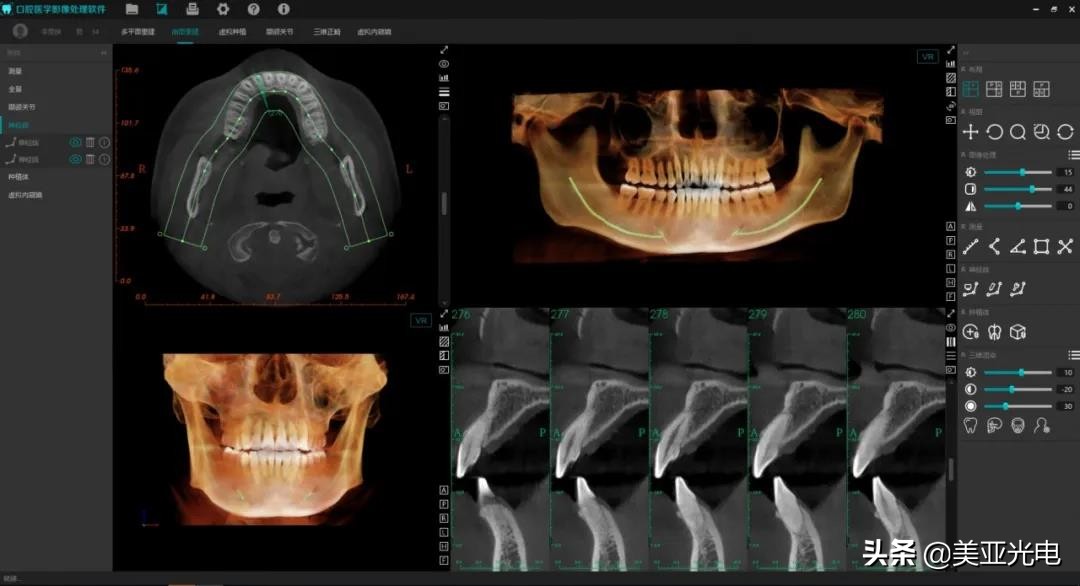 美亚口腔cbct全新局部ct功能上线,口腔cbct最好的品牌