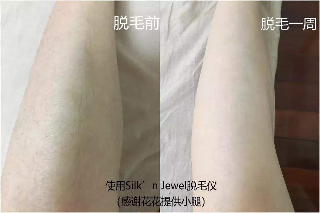 脱毛干货合集,史上最全脱毛仪