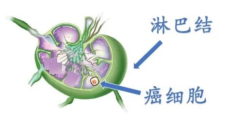 甲状腺术后见异常淋巴结什么意思,甲状腺术后病理有淋巴结转移2枚
