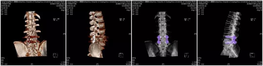 椎间盘突出和椎管狭窄症状的区别,腰椎管狭窄症的症状