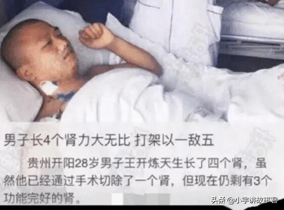 到底有没有四个肾的人,你知道四个肾的人多苦恼吗