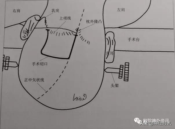 松果体占位怎样治疗,松果体区占位看什么科室