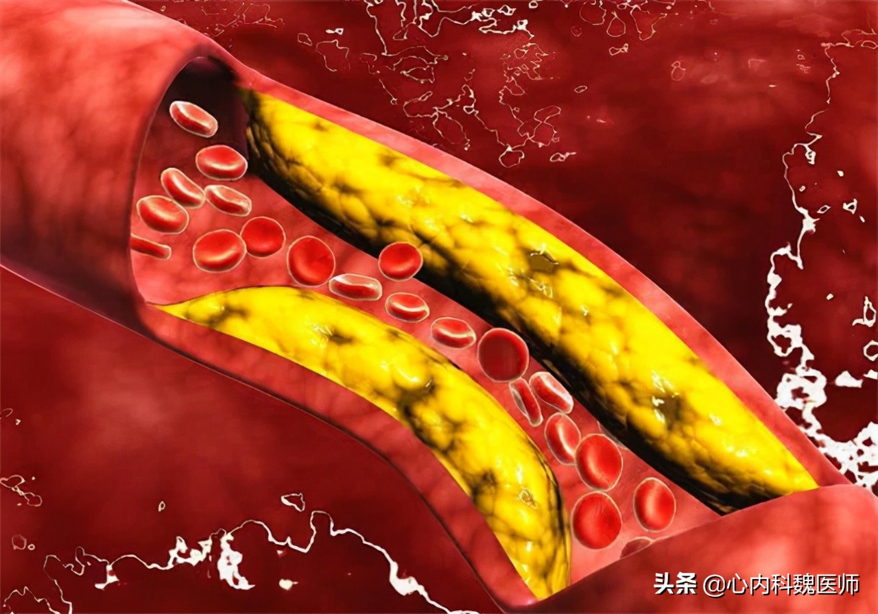 甘油三酯很高吃什么药才能降脂,甘油三酯高多少需要降脂药