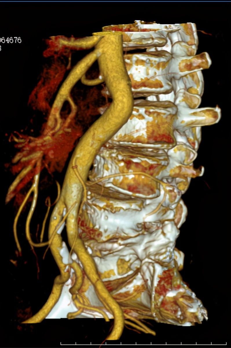 罕见肿瘤中医治疗案例视频,罕见肿瘤中医治疗案例