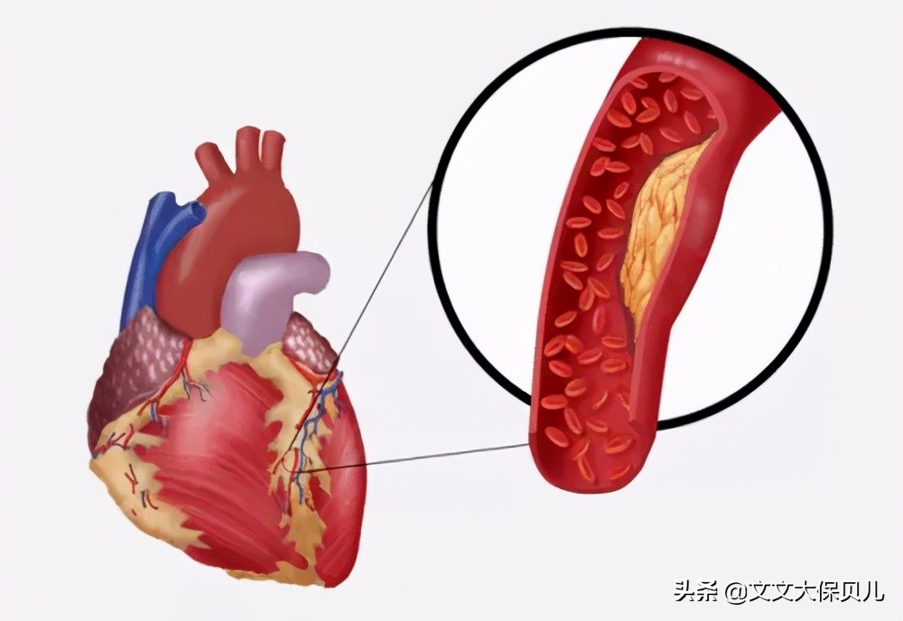 窦性心动过缓stt异常,窦性心动过缓st-t改变什么意思