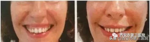 肉毒素能美白皮肤吗,肉毒素在医学美容的作用