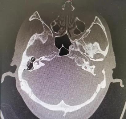中耳炎里面长了个瘤子,中耳炎长瘤子