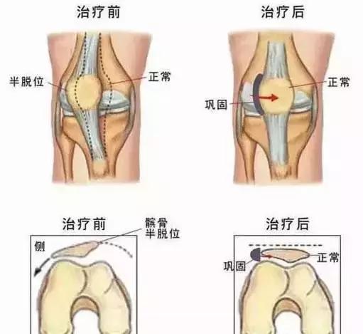 髌骨脱位了怎么办？！康复练习法有哪些（图文解说）