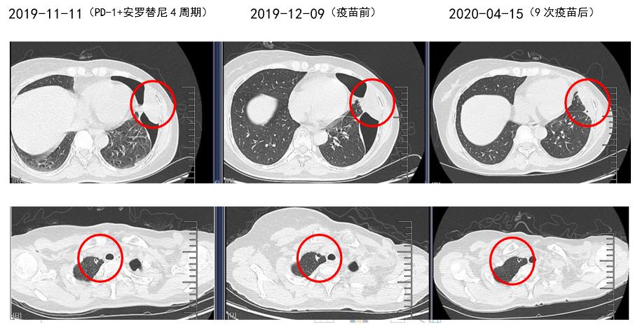 乳腺肉瘤免疫治疗,乳腺梭形细胞恶性肿瘤高级别