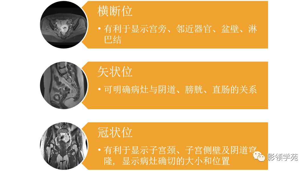 宫颈癌mri诊断,宫颈癌的mr扫描技术