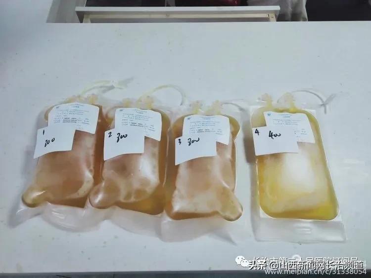 长治二院利用血浆置换术成功救治1名皮肌炎重叠干燥综合症患者