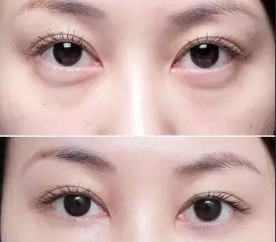 如何去眼袋拥有卧蚕,眼袋卧蚕和泪沟区别