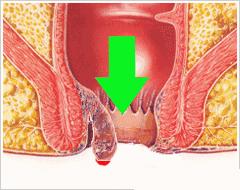 痔疮症状表现有便意拉不出,血栓痔疮的表现症状是什么