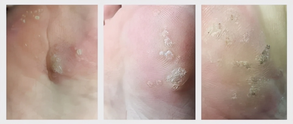 脚上长了跖疣能自愈吗,跖疣冷冻后变刺瘊