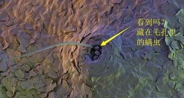 你知道黑头是怎么形成的吗,怎么分辨黑头的严重程度