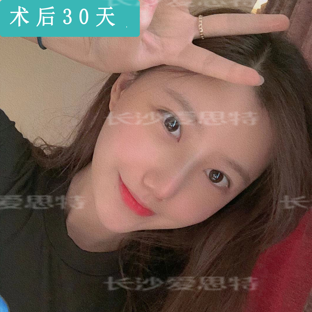 耳软骨隆鼻大概多久恢复正常,隆鼻耳软骨取出后可以恢复原样吗