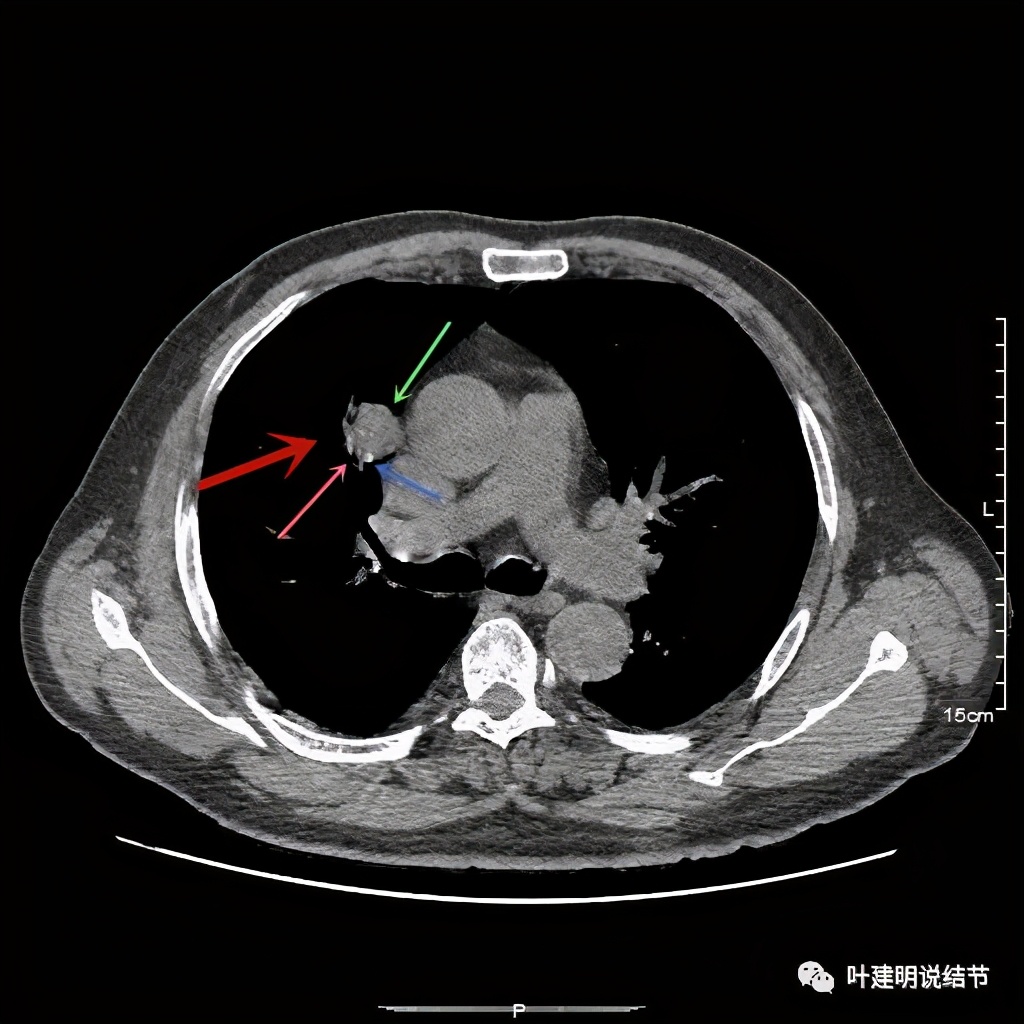 误诊报告图片,误诊案例及案例分析