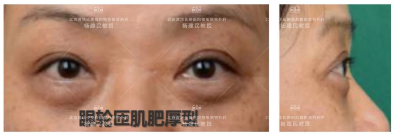 如何分清自己是哪种类型的眼袋,怎么看是哪种类型的眼袋