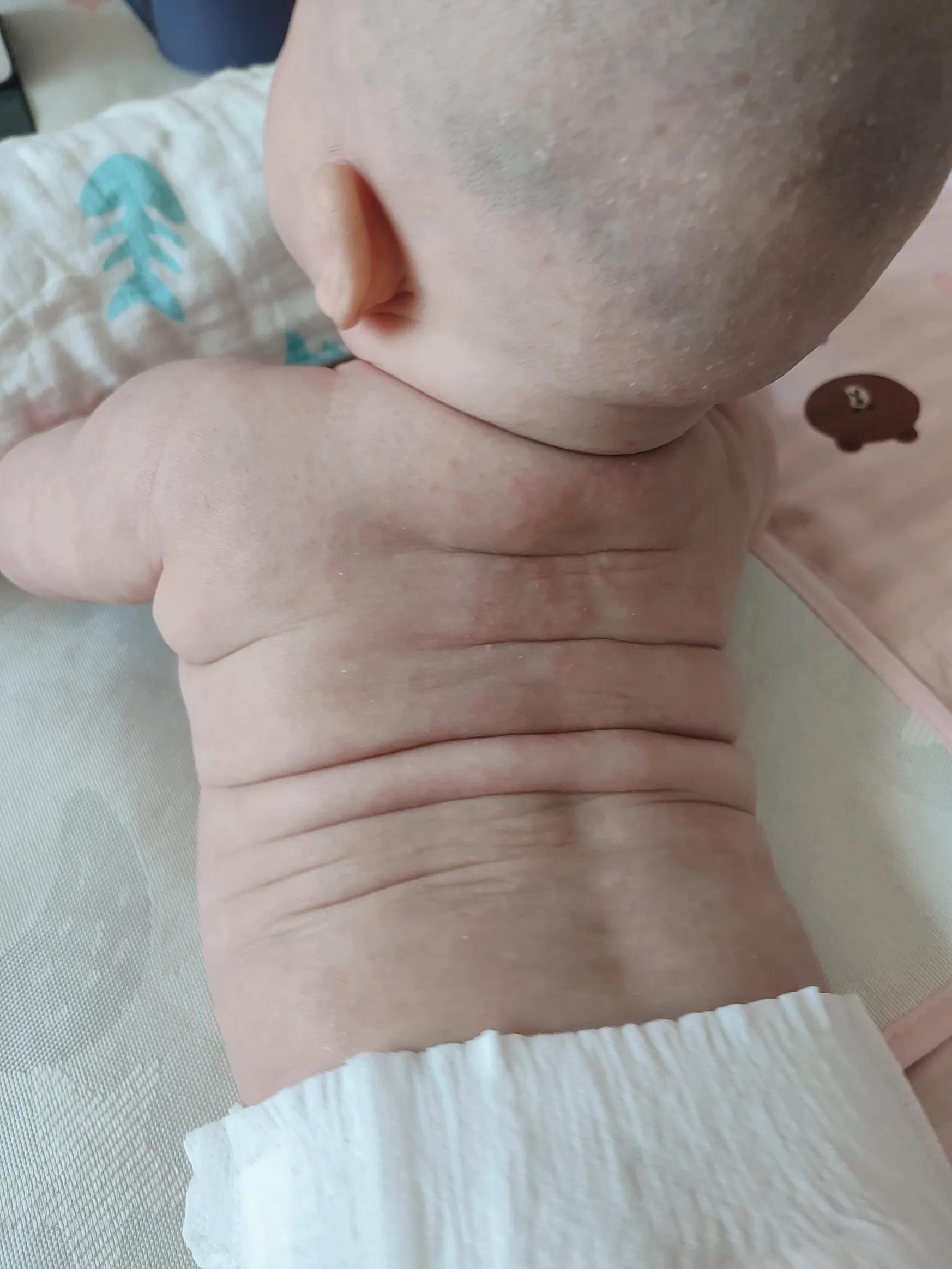 宝宝大作战8-9,宝宝湿疹大作战