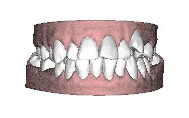 一分钟带你看牙齿矫正的全过程,最常见的牙齿矫正问题速度收藏