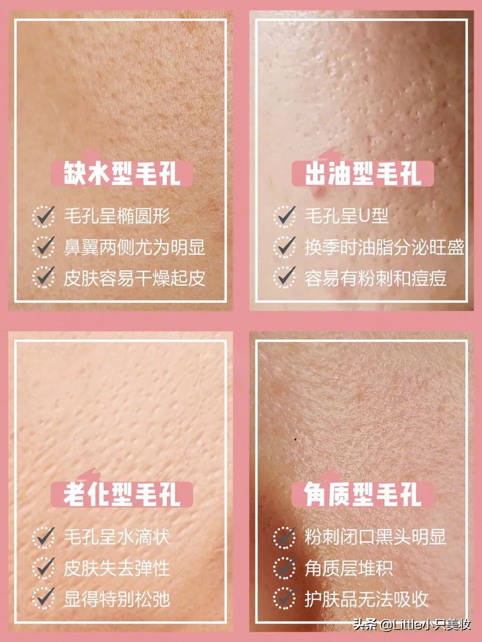 简单几招让你迅速解决粗大毛孔,改善毛孔粗大最有效的办法测评