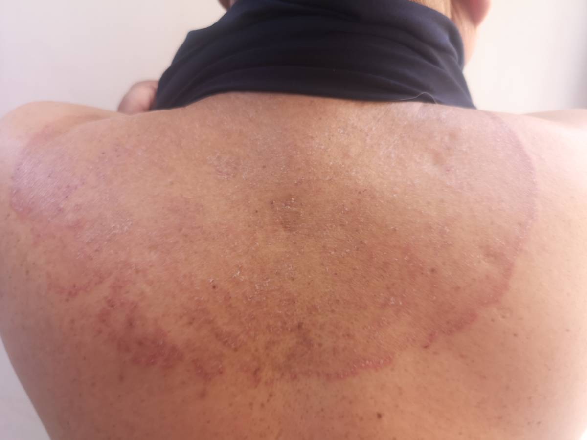 远离真菌感染,真菌性皮肤病的克星