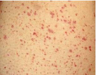 宝宝腿上有瘀青一定就是紫癜吗,儿童腿上毛细血管明显是不是紫癜