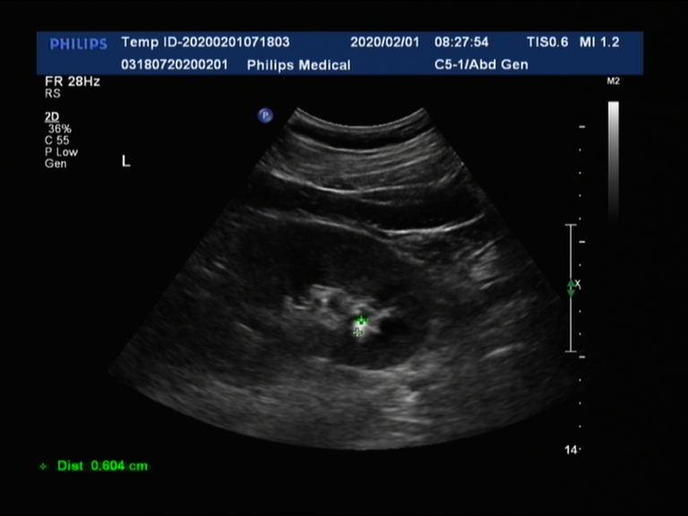 排石冲剂有没有效果,排石颗粒是小便排吗